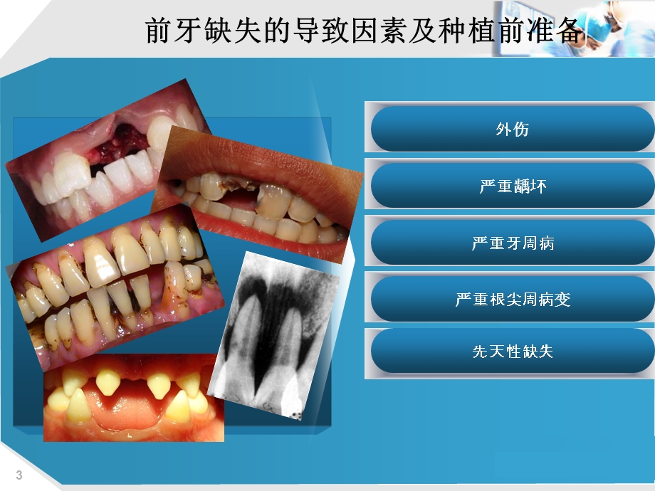 种植手术中的基本 外科原则.ppt_第3页