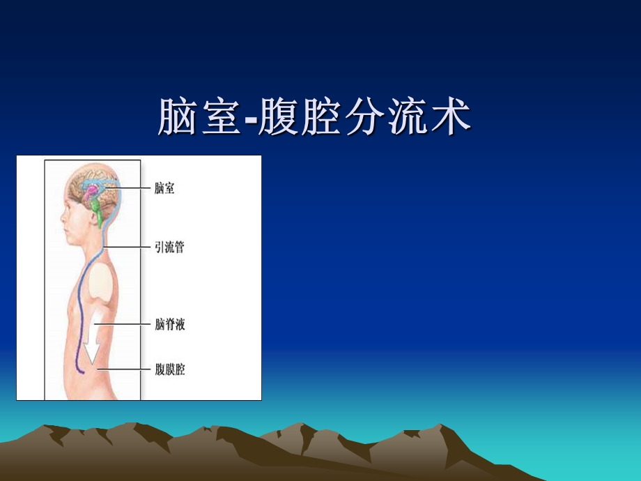 脑室腹腔分流术.ppt_第1页