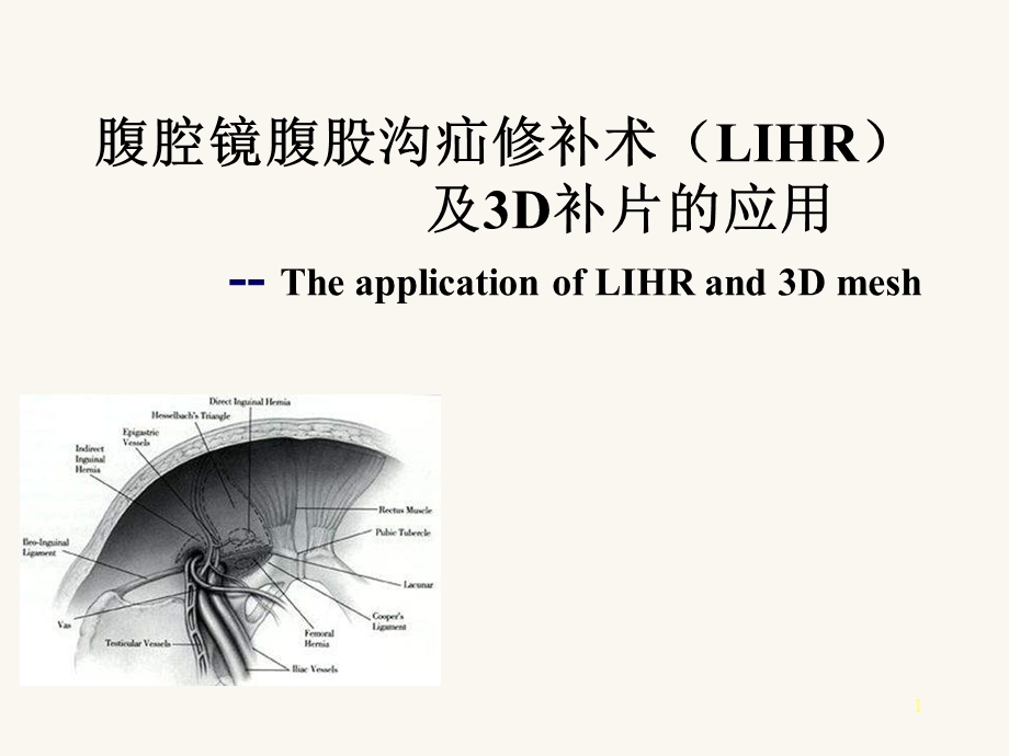 腹腔镜腹股沟疝修补术.ppt.ppt_第1页