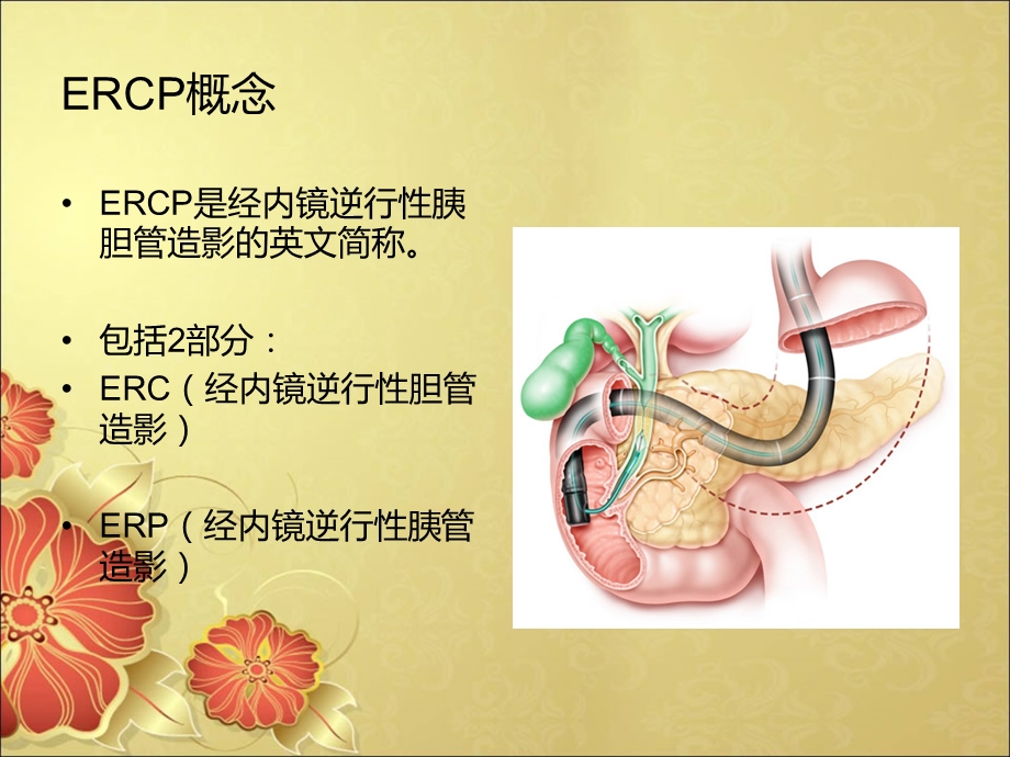 胆总管结石ERCP术围手术期护理.ppt_第3页