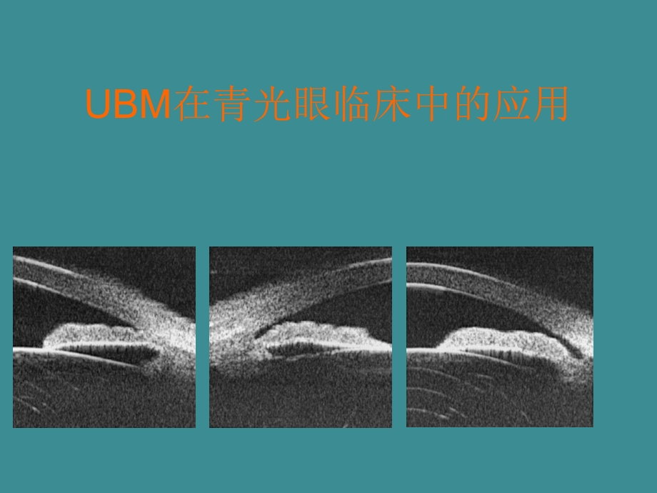 UBM在青光眼临床中的应用.ppt_第1页