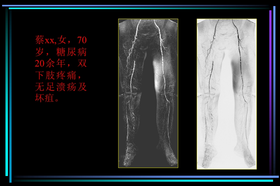 CEMRA对糖尿病足血管病变的诊断价值.ppt_第3页