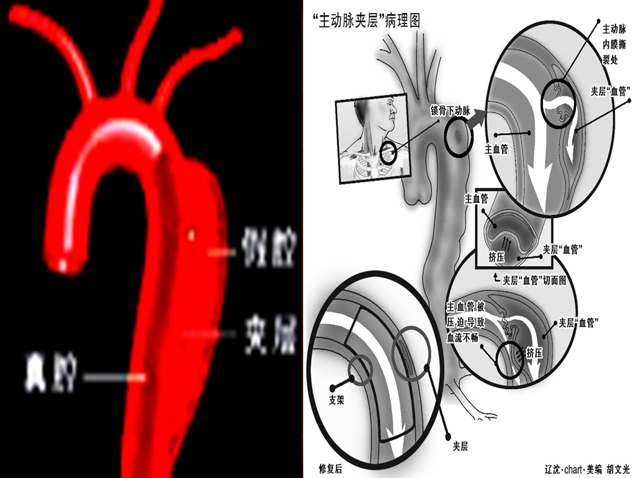 主动脉夹层的诊断.ppt.ppt_第3页