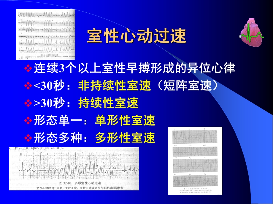 室速心电图.ppt_第3页