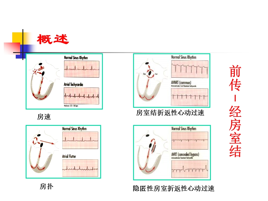 【精品】窄QRS波心动过速83.ppt_第3页