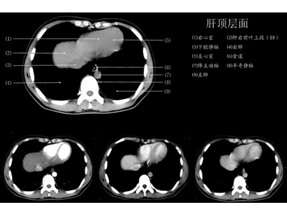 上腹部CT各个层面.ppt_第2页