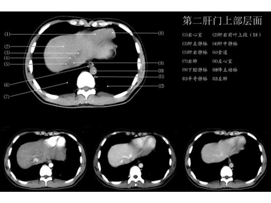 上腹部CT各个层面.ppt_第3页