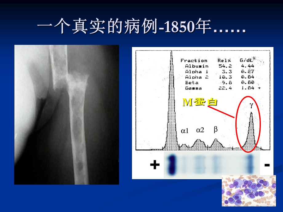 多发性骨髓瘤早期诊断和治疗精要.ppt_第3页