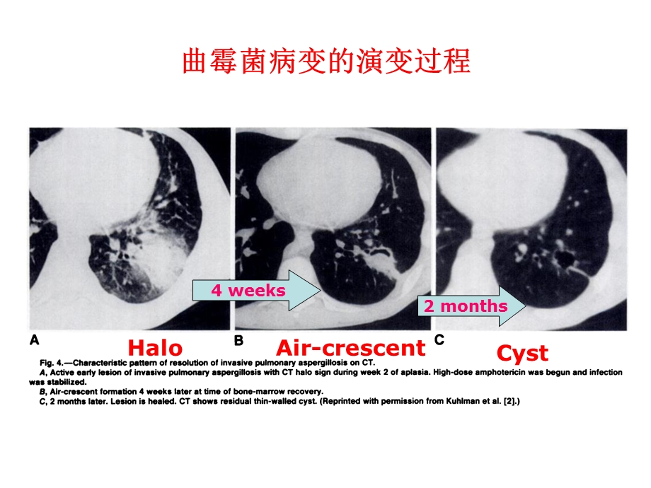 医院肺真菌病的影像诊断4.ppt_第3页