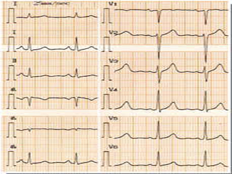 心电图图谱分析.ppt_第2页