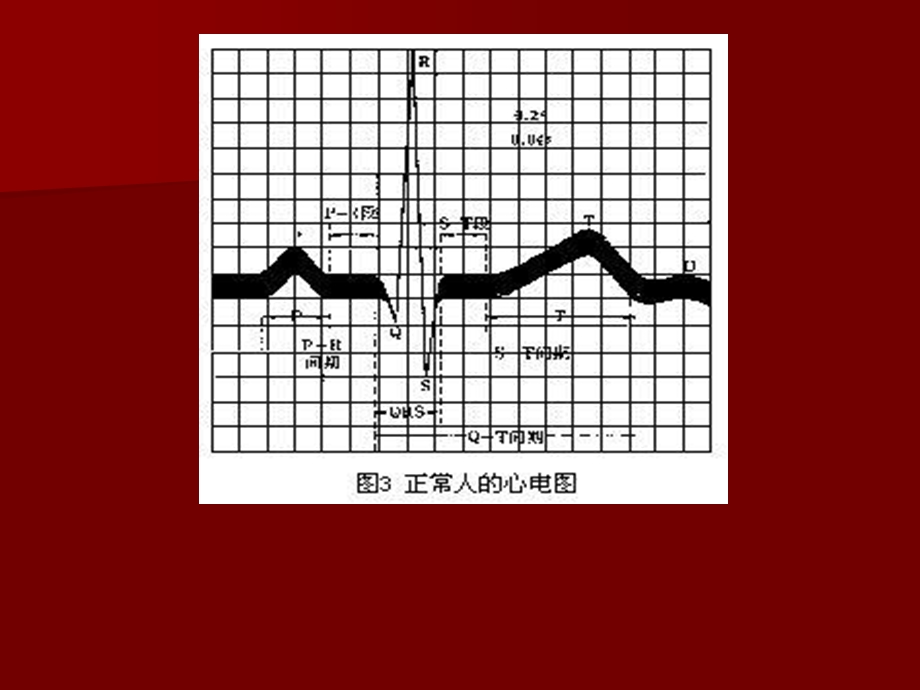 动态心电图基夲知识介绍.ppt_第3页