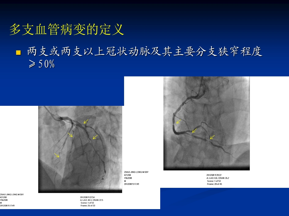 多支病变优先处理血管的选择.ppt_第2页