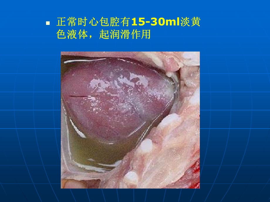 【精品】心包积液.ppt_第3页