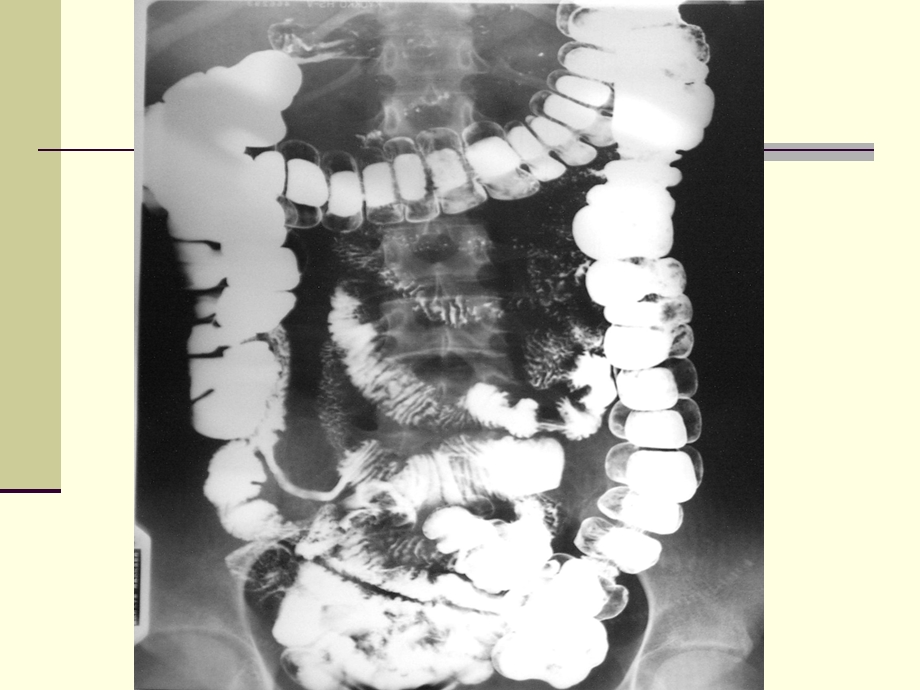 大肠疾病影像学诊断幻灯片.ppt_第2页