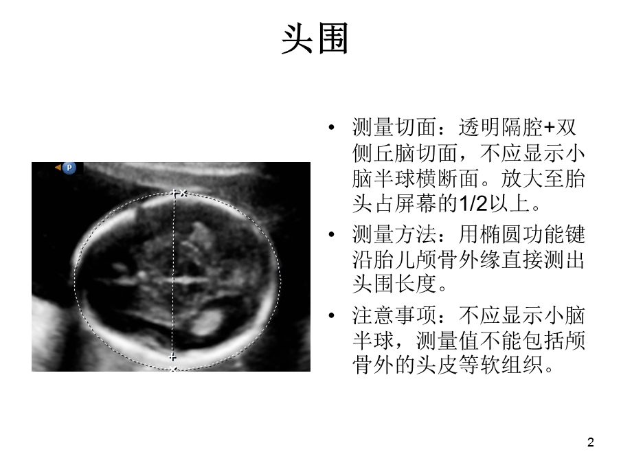 产科超声标准切面25张图.ppt_第2页