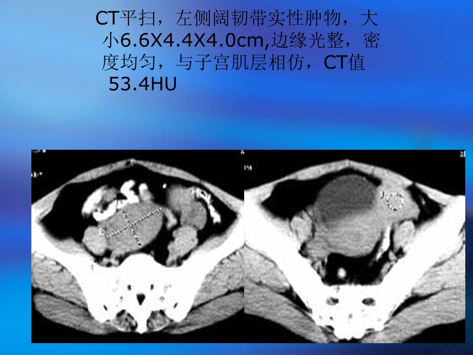 CT在女性生殖系统的应用.ppt_第3页