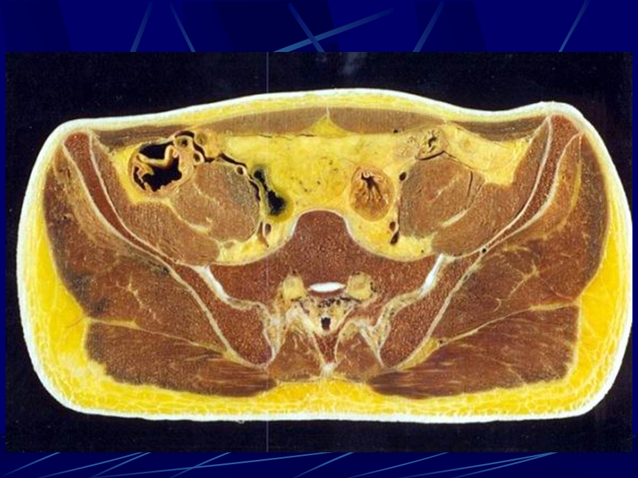 男性盆部和会阴断层解剖.ppt_第3页