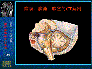 脑膜、脑池、脑室CT解剖.ppt.ppt