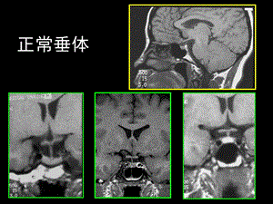 鞍区解剖及病变.ppt