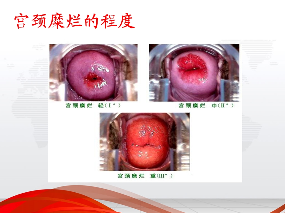 女性健康知识讲座(宫颈疾病).ppt_第3页