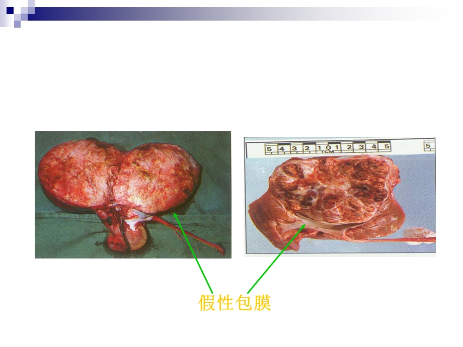 泌尿系肿瘤病人的护理..ppt_第3页