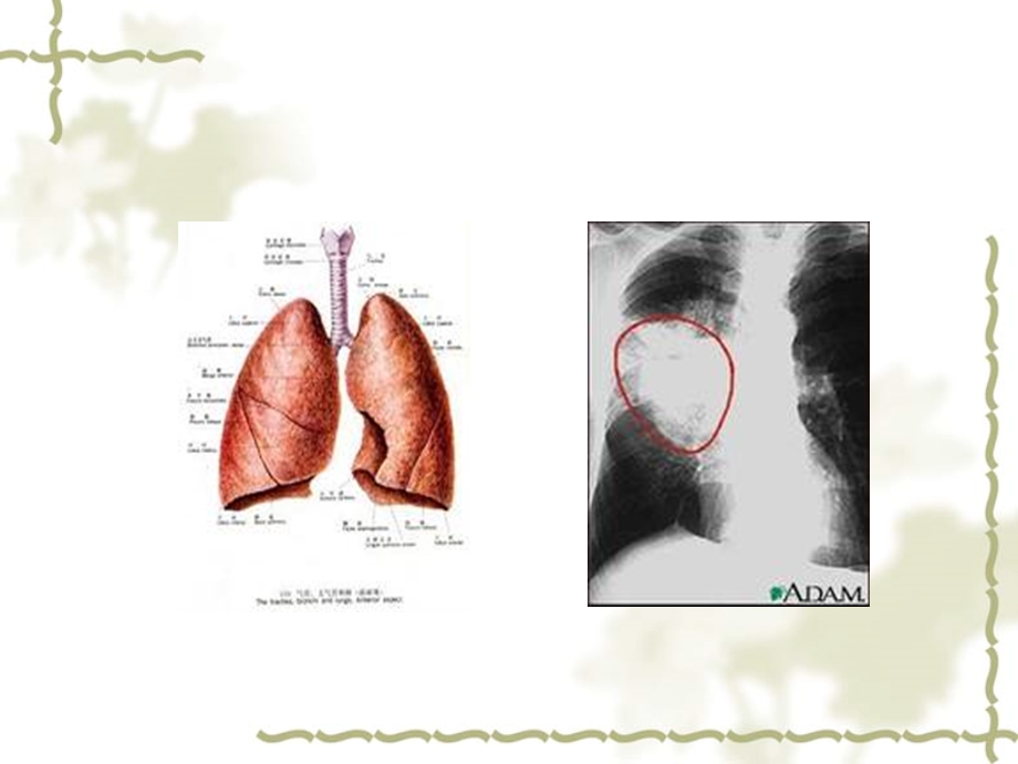 肺癌ppt课件.ppt_第2页