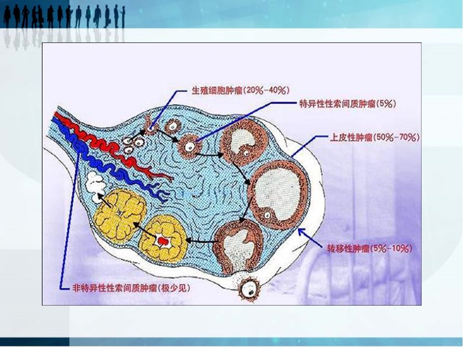 卵巢上皮源性肿瘤病变影像学表现.ppt_第3页