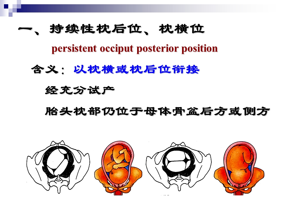 胎位异常教案PPT.ppt_第3页