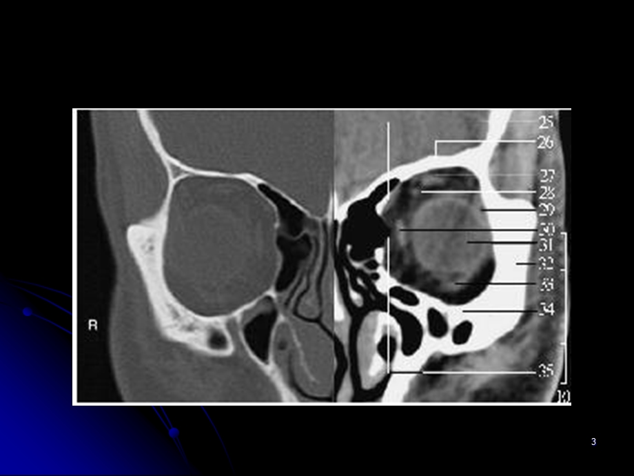 常见眼眶内原发性肿瘤的诊断(一） .ppt_第3页