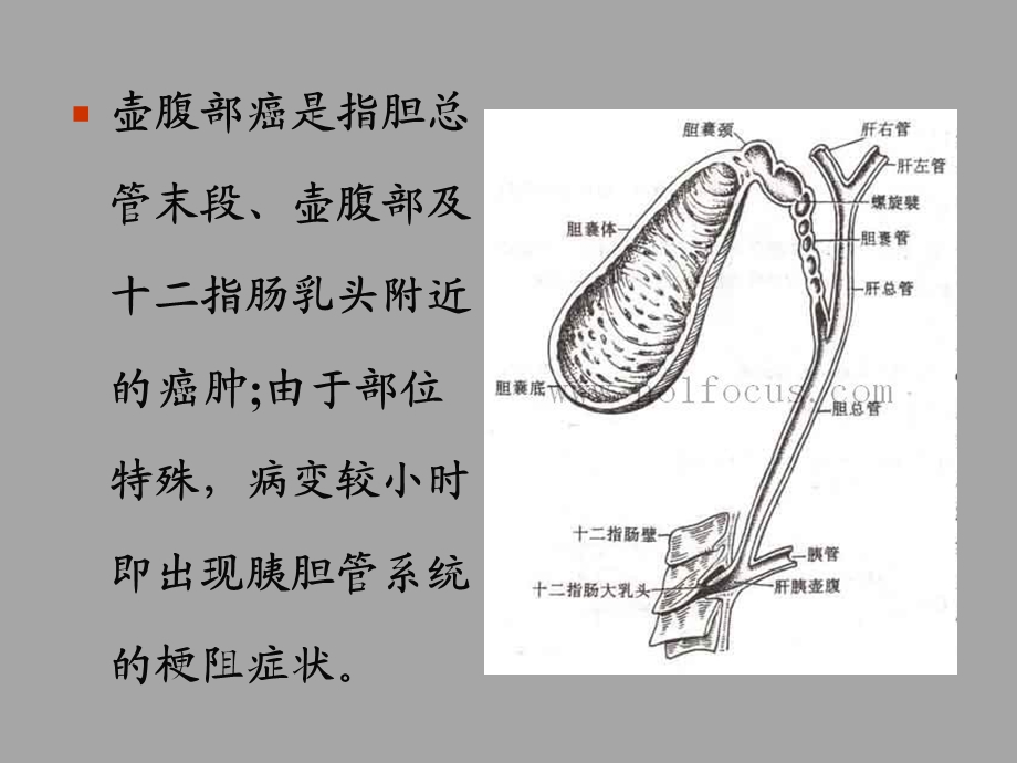 Vater壶腹癌的影像学表现及TNM分期.ppt_第2页