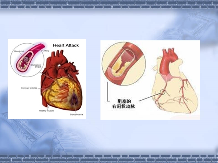 急性冠脉综合征1.ppt_第3页