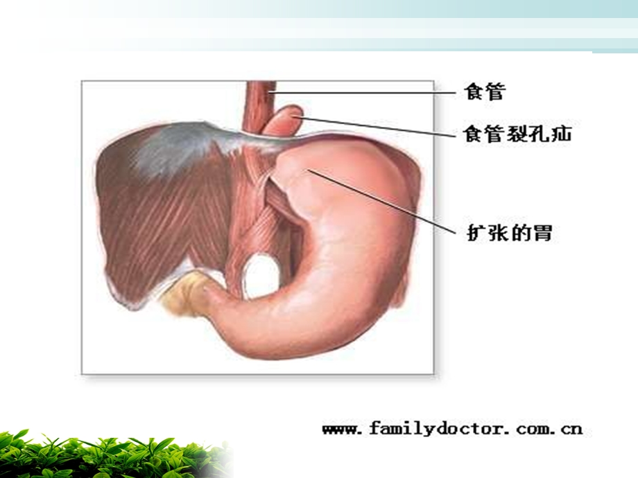 食道裂孔疝护理.ppt_第3页