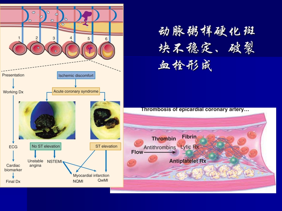 急性冠脉综合征的诊断与治疗.ppt_第2页