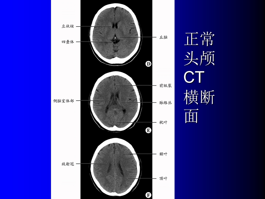 医学影像诊断学—头颈部病例.ppt_第3页