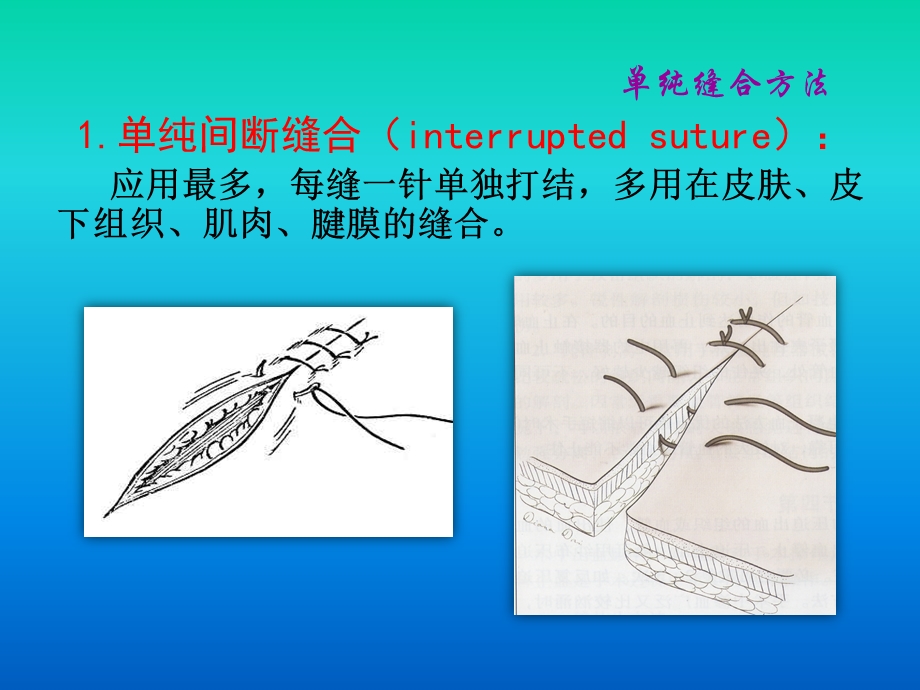 离体肠管吻合.ppt_第3页