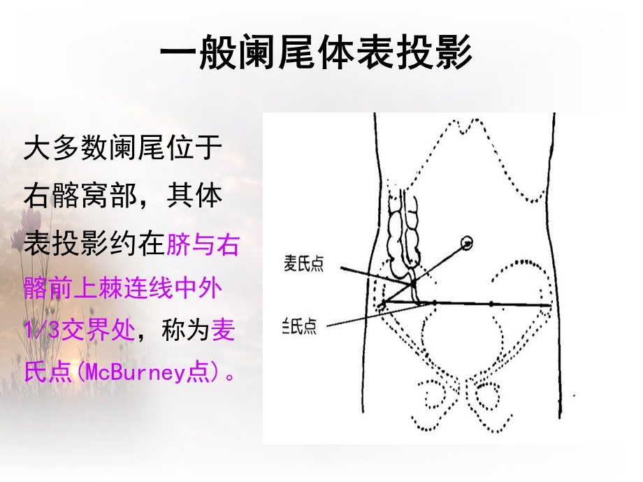 急性阑尾炎.ppt_第3页