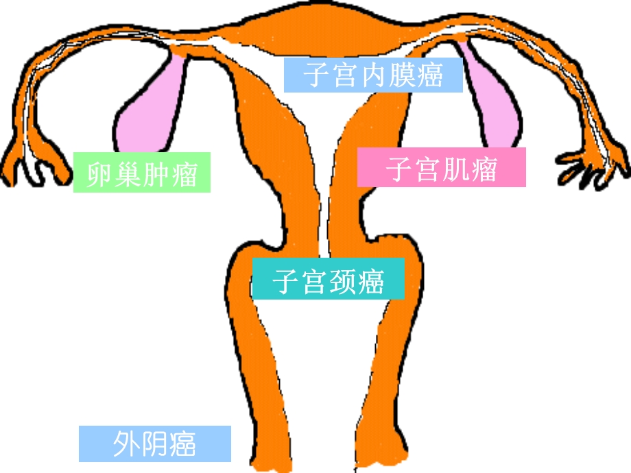 子宫颈癌PPT.ppt_第1页