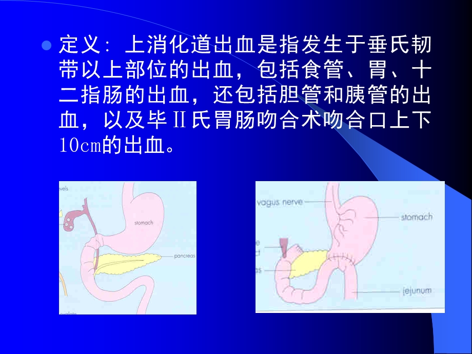 上消化道出血的诊断和处理.ppt_第2页