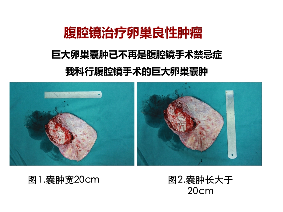 妇科腹腔镜现状思考与展望.ppt_第3页