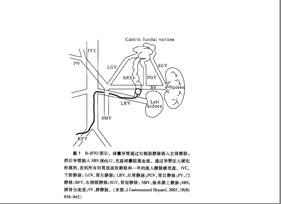 肝硬化门脉高压症的BRTO治疗.ppt.ppt_第3页