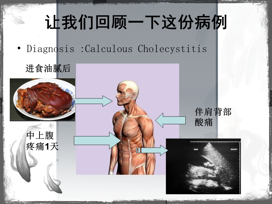 结石性胆囊炎的诊断和治疗.ppt_第2页