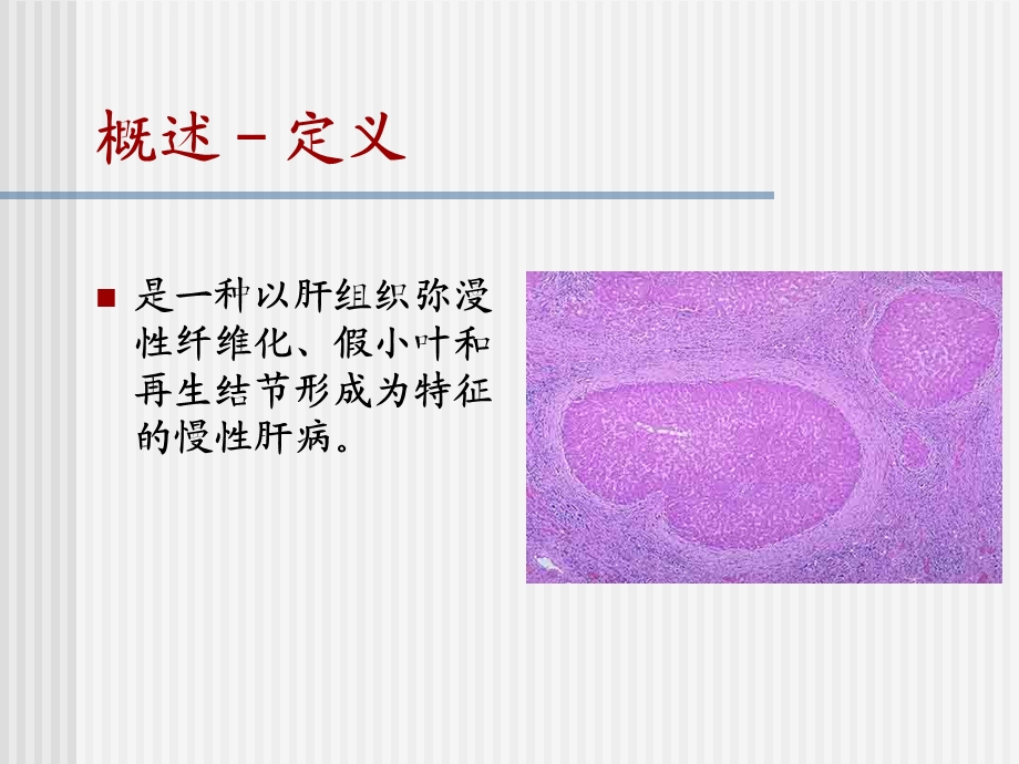 肝硬化消化内科.ppt_第3页