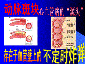 颈动脉斑块专题.ppt