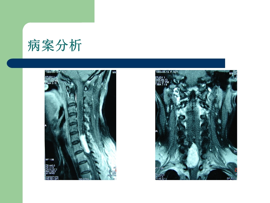 医学神经鞘瘤.ppt_第3页