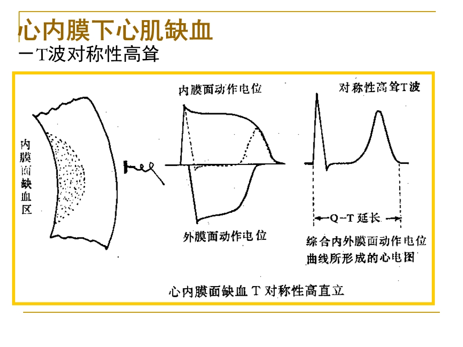 第四次课心肌缺血、梗塞.ppt_第2页