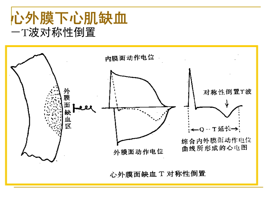 第四次课心肌缺血、梗塞.ppt_第3页