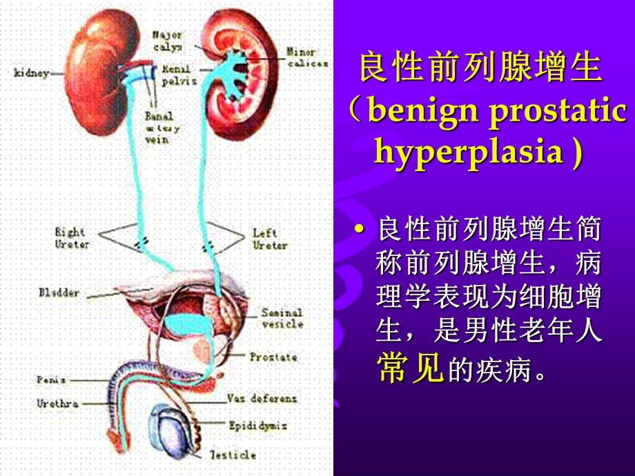 前列腺增生.ppt_第2页