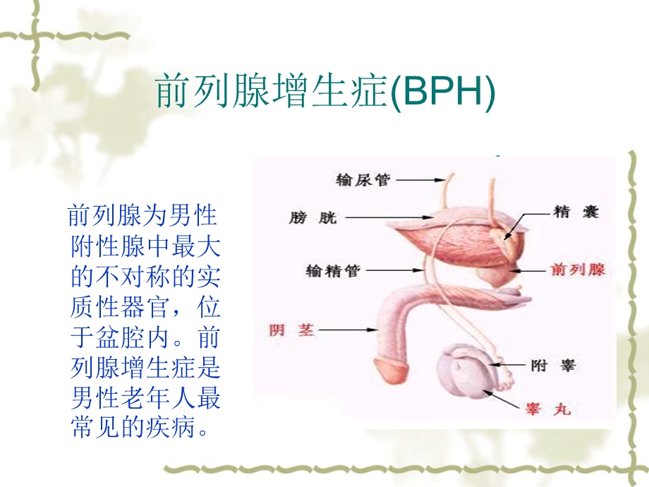 前列腺增生症.ppt_第2页