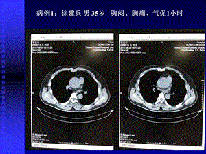 主动脉夹层影像学诊断.ppt