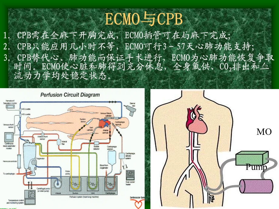 ECMO技术临床应用.ppt_第3页